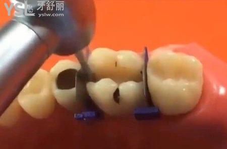 牙齒縫隙里很臭怎么回事？