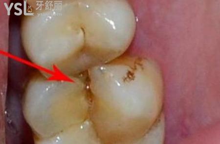 牙齒劈了一半怎么修復(fù)？