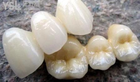 陶瓷牙一顆多少錢(qián)？