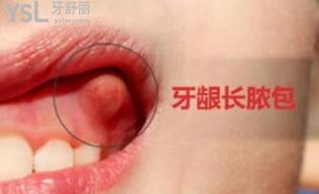 牙銀上長個膿包怎么辦？
