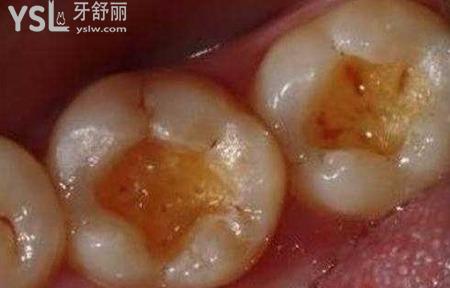 補(bǔ)蛀牙的價(jià)格是多少？