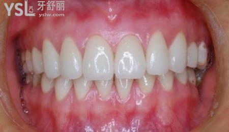 牙槽突裂是怎么發(fā)育的？