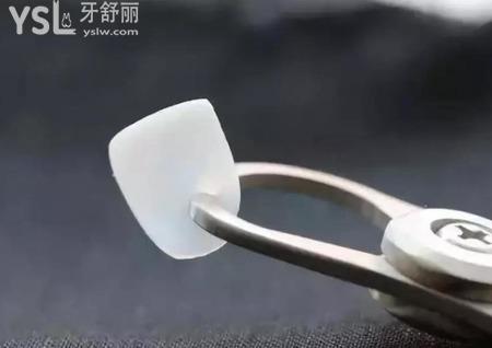 牙貼面能維持多久？