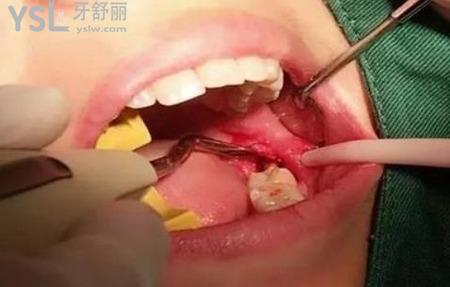 拔智齒后一周吃什么？