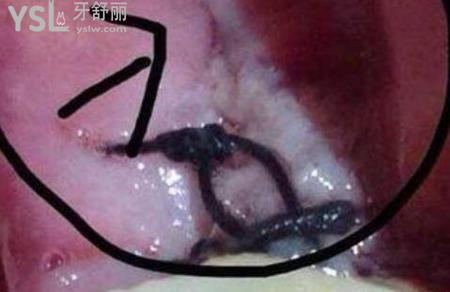拔牙縫針不拆線后果是什么？