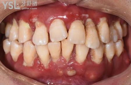 牙齒軟是什么原因？