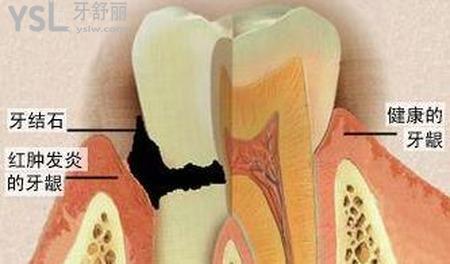 牙周炎有什么癥狀？