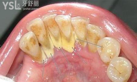牙齒上有黃垢怎么辦？