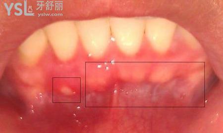 牙齦腫痛不能吃什么東西？