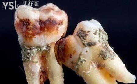 阻生齒拔掉后有個洞怎么辦？