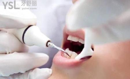洗牙兩小時(shí)后能抽煙嗎？