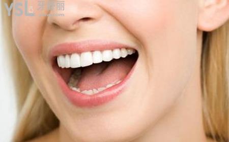 美容冠矯正牙齒多少錢？