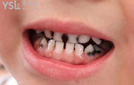 小孩子蛀牙怎么辦?要不要治療?