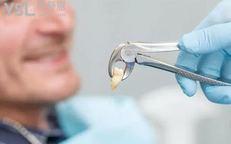 拔智齒后謹記注意事項和禁忌知多少?