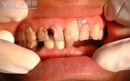 小孩拔牙后多長時間才能長牙齒？