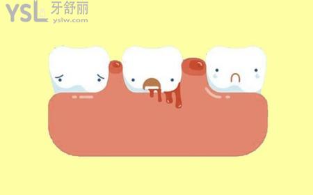 牙齒一吸就出血是什么原因？