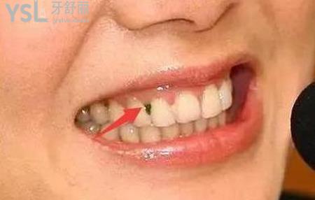牙縫塞東西,摳出來很臭是怎么回事？
