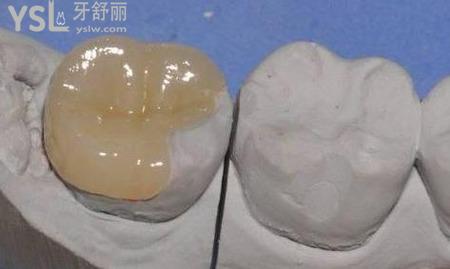 正規(guī)醫(yī)院補(bǔ)牙洞的價(jià)格是多少錢呢?