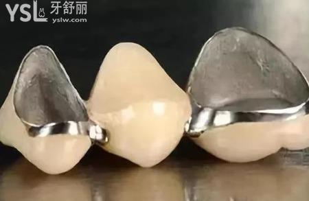 烤瓷牙是怎么安裝的？