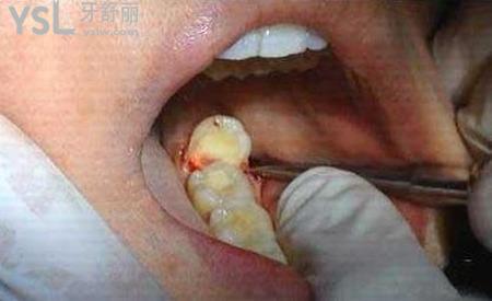 大家拔完智齒后臉都腫幾天??？