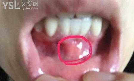 牙根發(fā)炎腫得非常好的我該怎么辦呢？