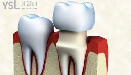 做個(gè)牙冠需要多少錢(qián)？