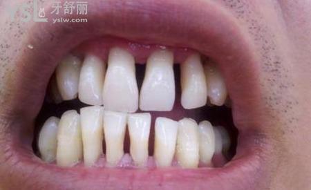 牙齦萎縮之后還能嗎？要怎么做？