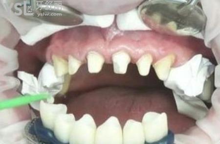 烤瓷牙牙套不會(huì)掉,可是里面的基牙都爛了是因?yàn)槭裁矗? class=