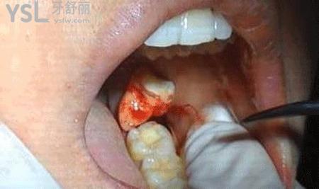 拔牙后反胃想吐怎么辦？