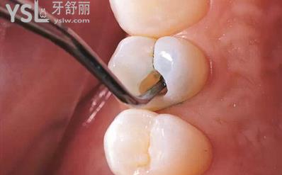 智齒爛了大洞不拔會(huì)怎么樣？