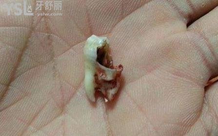爛牙根很臭要拔掉嗎？