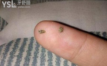 牙結(jié)石怎么去除多少錢？