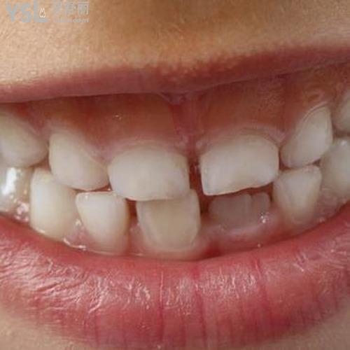 門(mén)牙被撞松動(dòng)了如何處理？