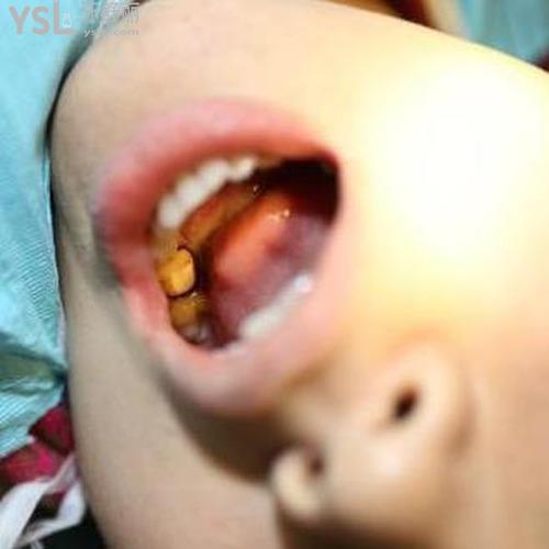 拔牙后頭暈無力是怎么回事？