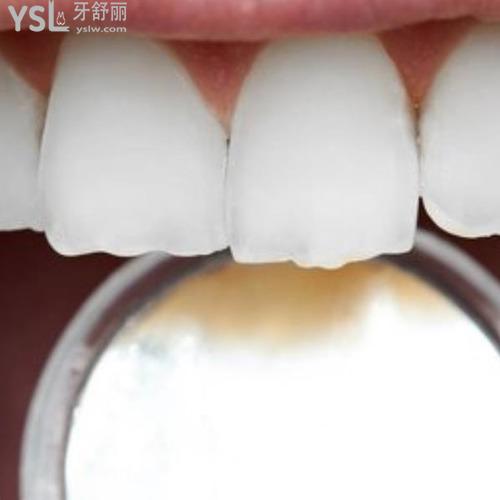 門牙可以補(bǔ)嗎掉了一點？