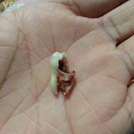 智齒蛀牙了補(bǔ)好還是拔掉好？
