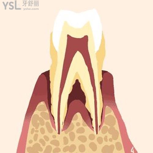 牙齒松動3度需要拔掉嗎？