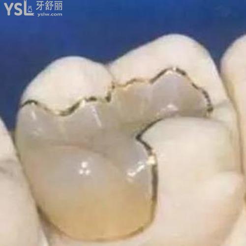 掉了一顆牙補(bǔ)牙怎么補(bǔ)？