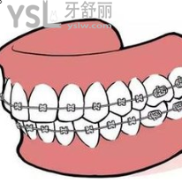 20歲的年輕人做牙套要做什么的？求解答