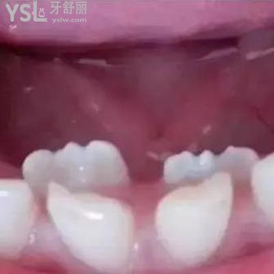 雙排牙齒要拔掉嗎?怎么治療？