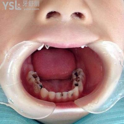 治療兒童蛀牙要多少錢？