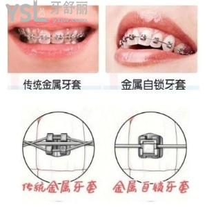 金屬自鎖托槽在牙套中矯正速度是最快的嗎？