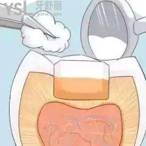 剛補(bǔ)好的牙就掉了一塊怎么辦？