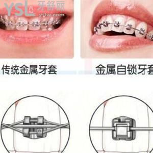 一般托槽牙套是怎么加力的 怎么選擇牙套類型？