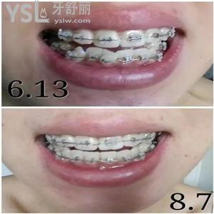 為什么成人不能矯正牙齒？