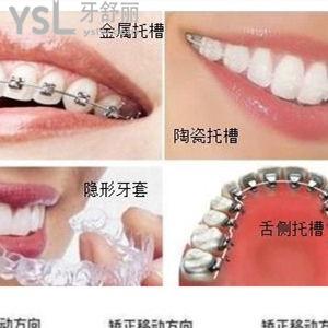 金屬自鎖牙套三萬元貴不貴？