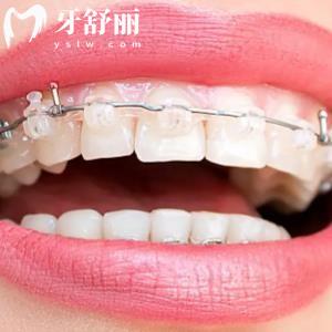 美國Ormco奧美科冰晶托槽牙套