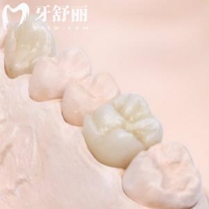 日本則武氧化鋯全瓷冠