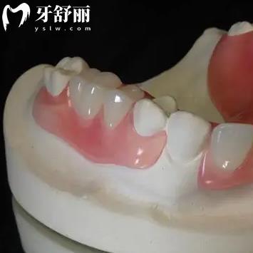 隱形義齒修復(fù)