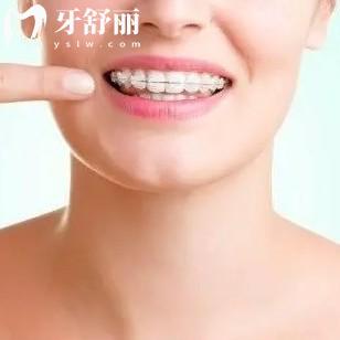 陶瓷托槽隱形牙齒矯正